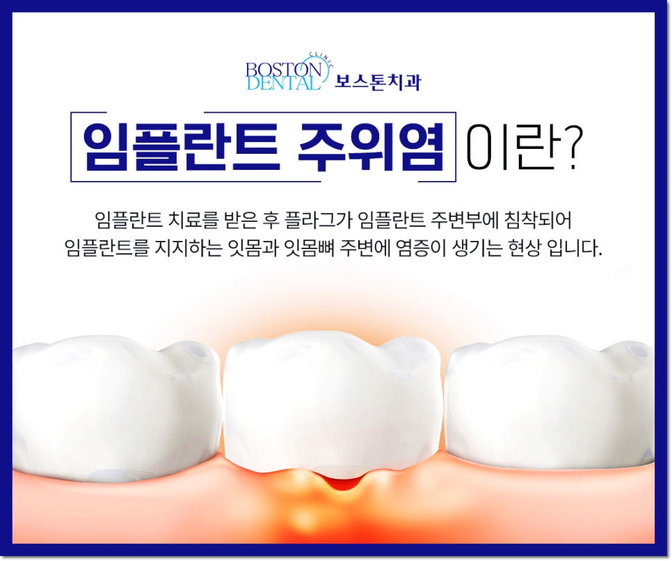 종로3가치과 틀니 사용 중인데 불편해서 임플란트 하고 싶어요 관련 이미지 7