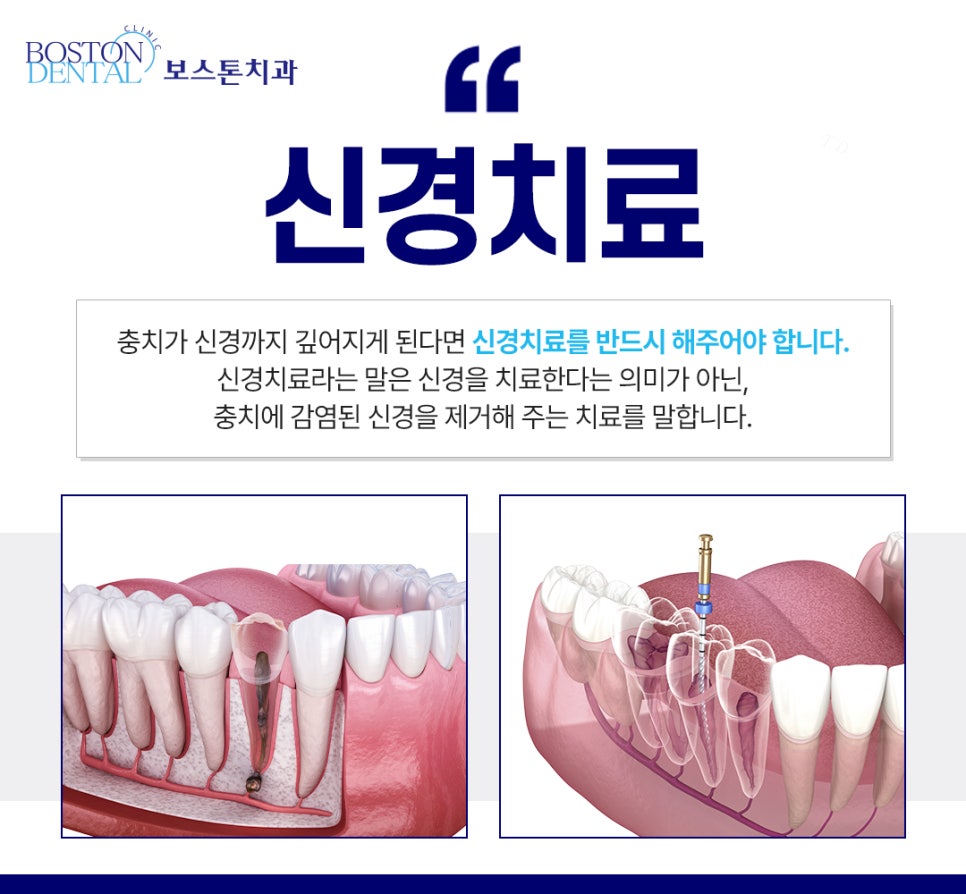 외국인치과 충치, 신경치료 고민하고 계신가요? 관련 이미지 3
