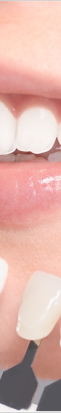 명동라미네이트, 단시간에 환한 미소를 가지고 싶다면? 관련 이미지 22