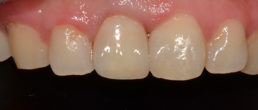 을지로치과 오래된 보철로 앞니가 보기 싫어요ㅠ 관련 이미지 3