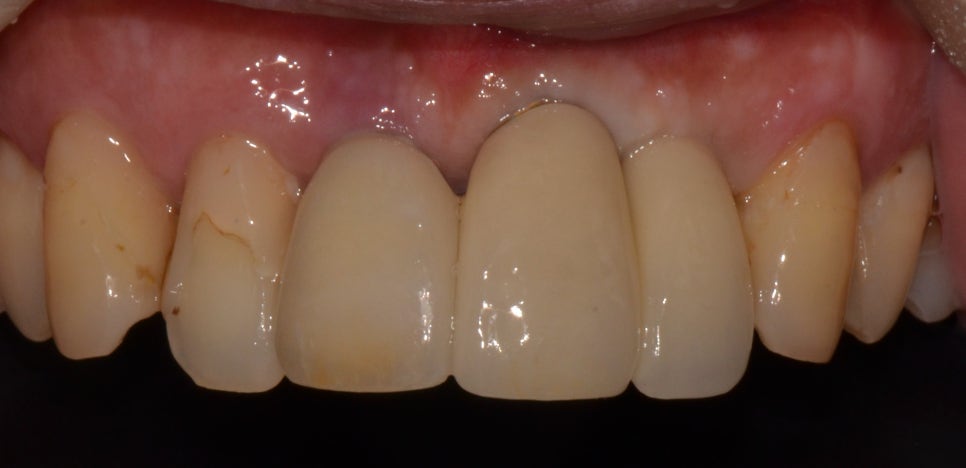 을지로입구역치과 앞니가 흔들리고 아파요 관련 이미지 6