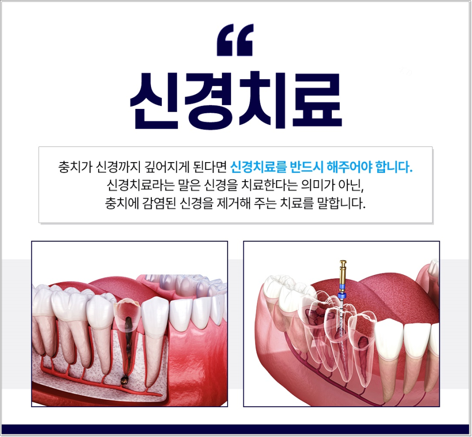 충치, 치료 미루면 더 아프고 더 비싸집니다 &ndash; 종각치과에서 꼭 알아야 할 이야기 관련 이미지 4