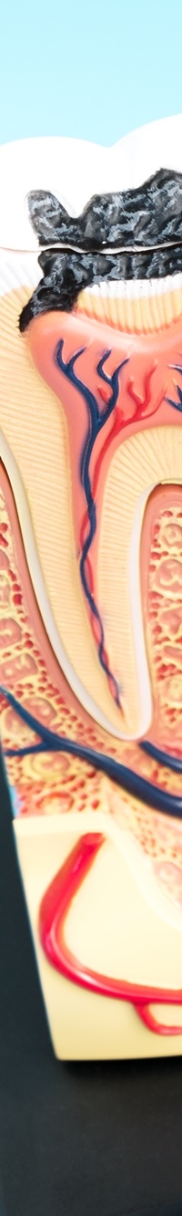 종각역치과 자연치아를 살리기 위한 대책, 신경치료 관련 이미지 29