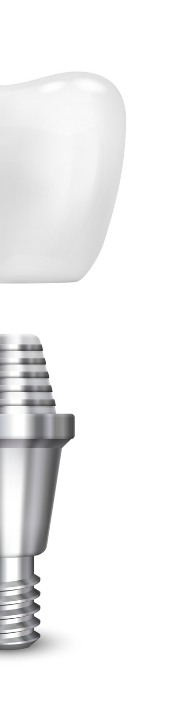 종로치과 임플란트 재식립이 필요하다면? 관련 이미지 10