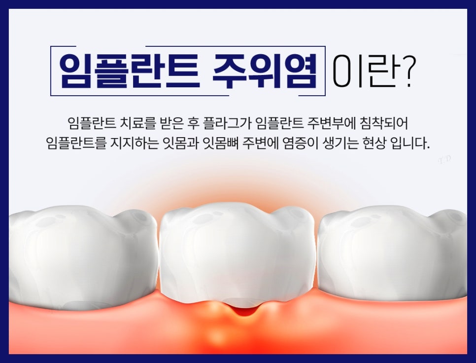 종각치과 임플란트 치료 후 관리 관련 이미지 5