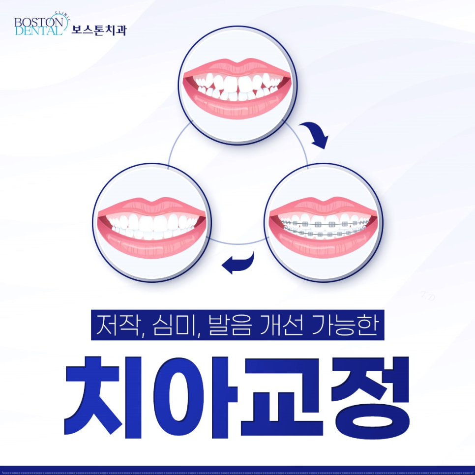 을지로치과 눈에띄지 않게 교정할 수 있는 방법 관련 이미지 1