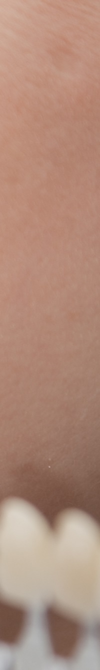 종로치과 자연스러운 라미네이트 색, 얼마나 하얘야 예쁠까? 관련 이미지 16