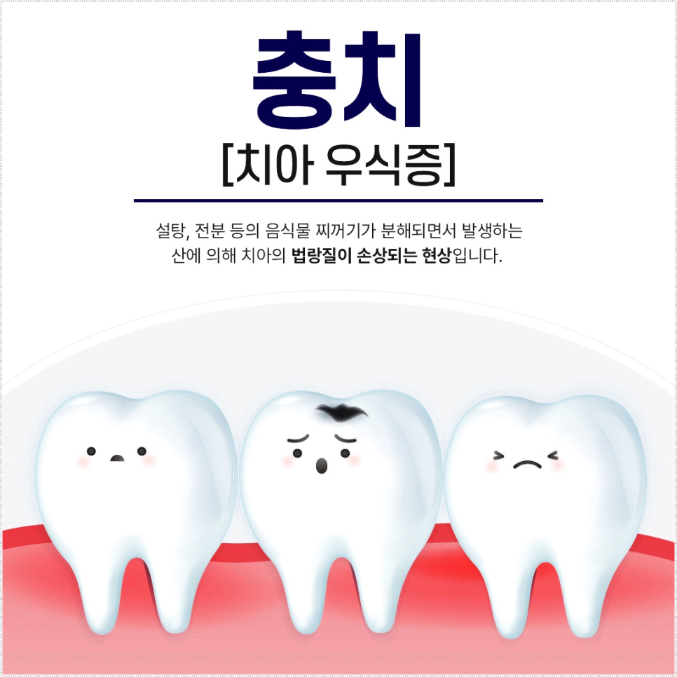 명동치과에서 들은 충치부터 신경치료까지 핵심정리 관련 이미지 1