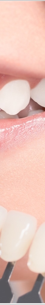 광화문치과 라미네이트 치료 전 고민해야 할 것 관련 이미지 30