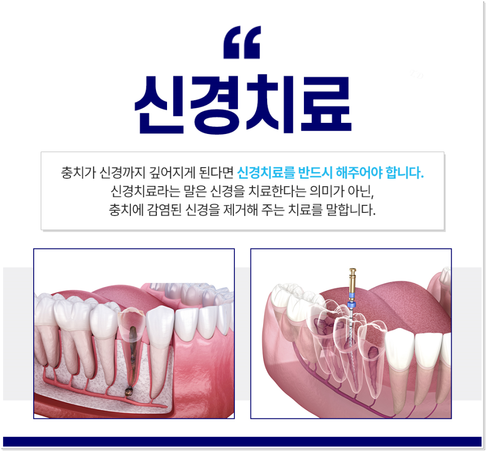 종로치과 충치치료는 조기 발견이 중요 관련 이미지 4