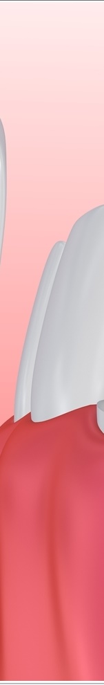 광화문치과 라미네이트 치료 전 고민해야 할 것 관련 이미지 16