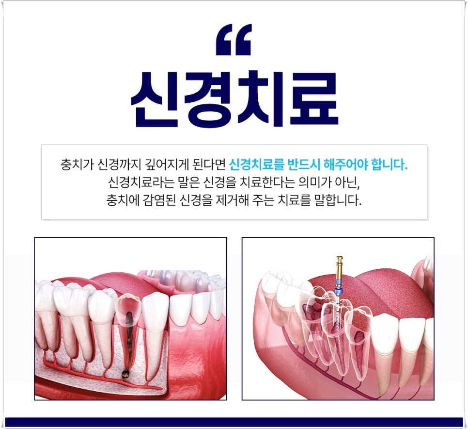 명동치과 치아가 욱씬욱씬 아프신가요? 관련 이미지 6