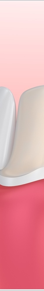 광화문치과 라미네이트 치료 전 고민해야 할 것 관련 이미지 17