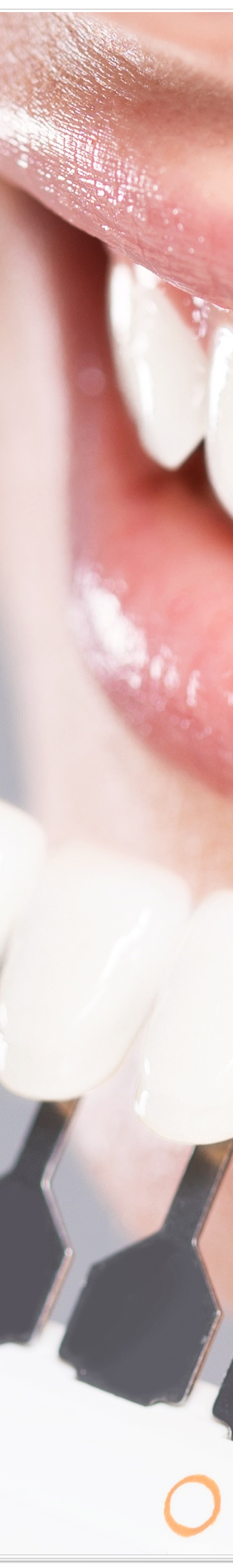 종로치과에서 알려드리는 치아미백과 라미네이트의 모든 것 관련 이미지 34