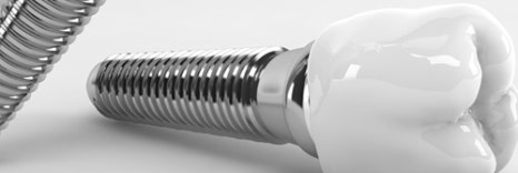 종각치과 고령층 임플란트, 왜 관련 이미지 18