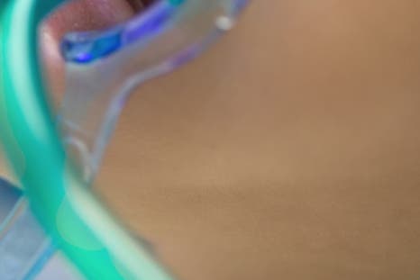 종로치과 치아미백 밝고 환하게 관련 이미지 15