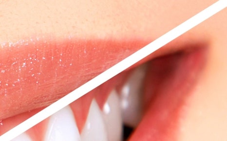 종로치과 치아미백 밝고 환하게 관련 이미지 18