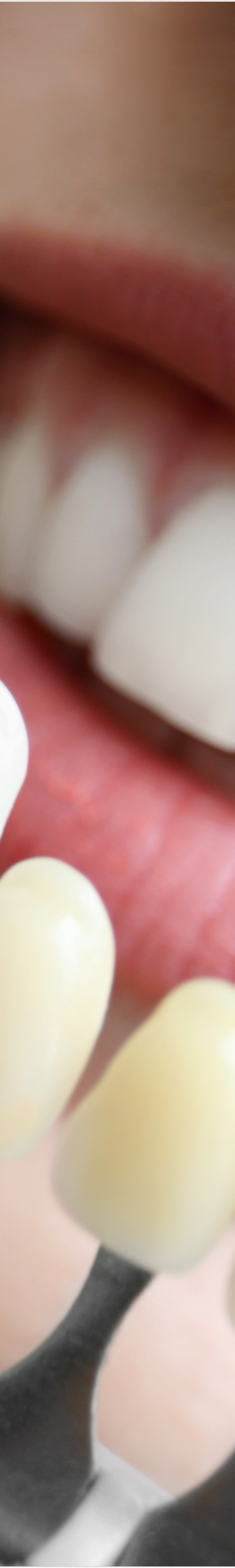 을지로입구역치과에서 알려드리는 치아미백과 라미네이트의 모든 것 관련 이미지 21