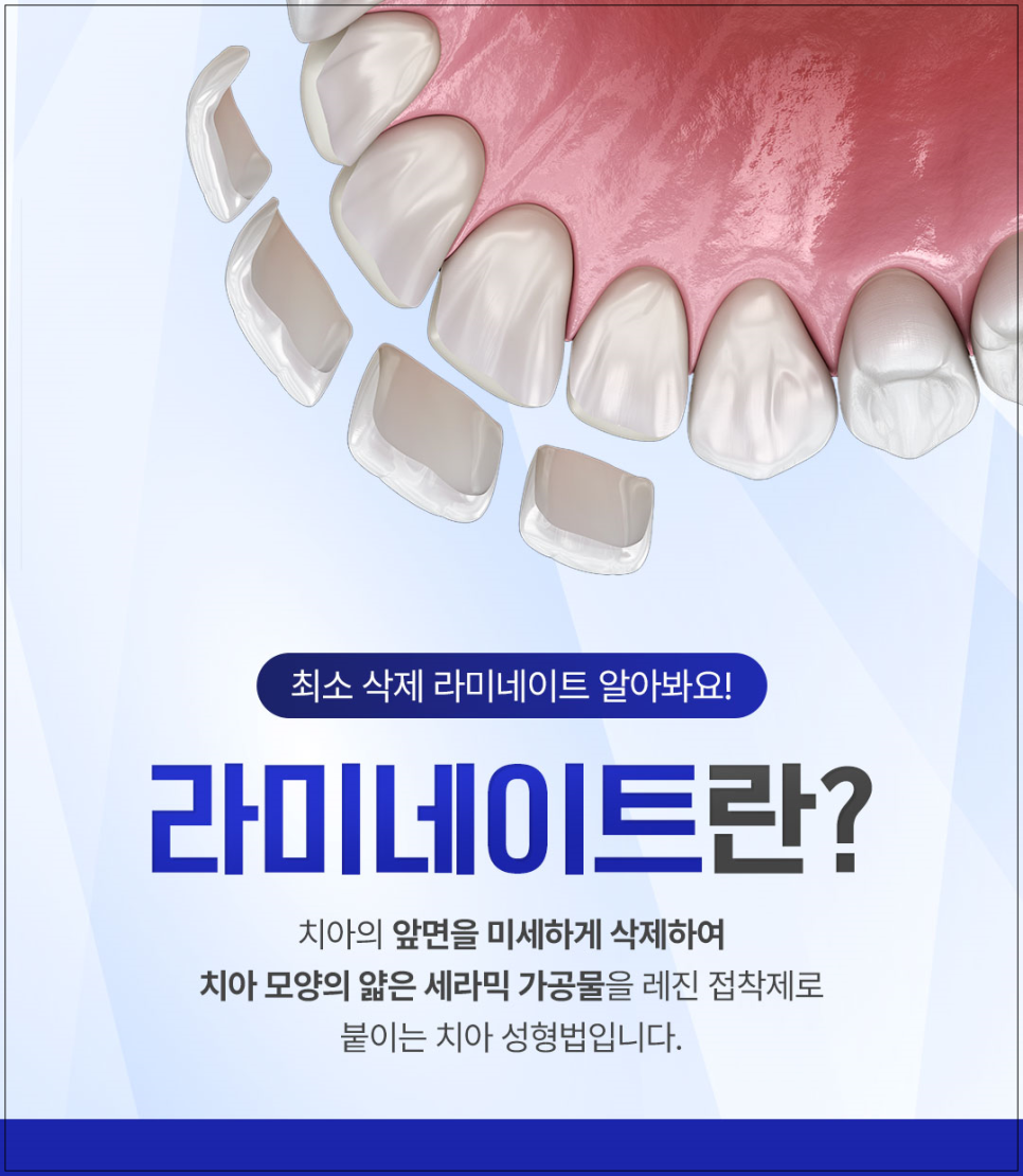 광화문치과 라미네이트 깨짐&middot;들뜸 원인과 예방 방법 완벽 정리 관련 이미지 4