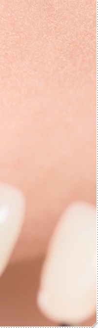 종로치과 라미네이트 주변 치아를 확인하여 자연스럽게 관련 이미지 26