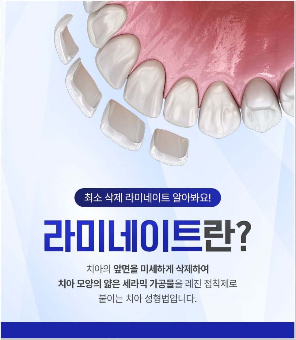 광화문치과 라미네이트 치료 전 고민해야 할 것 관련 이미지 2