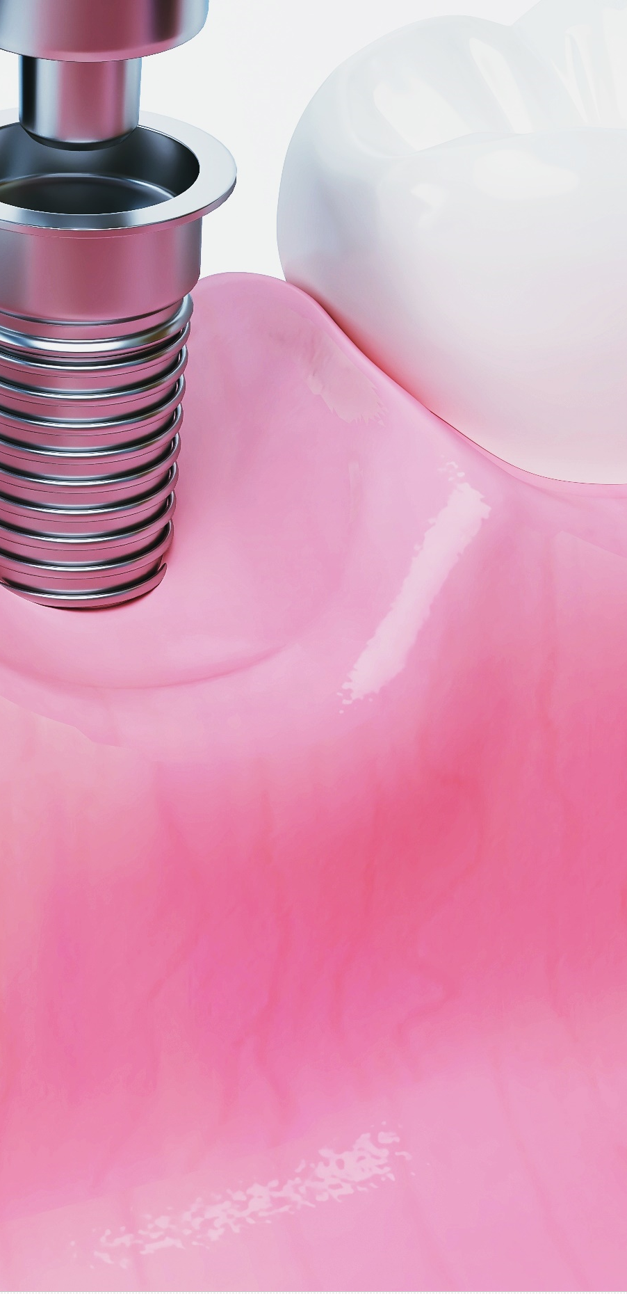 종각역치과 임플란트 치료, 이것만은 알고 계세요! 관련 이미지 44