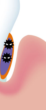 Cavity Treatment, Root Canal Treatment, and Essential Cavity Prevention Tips from a Jongno-gu Dental Clinic! image 27