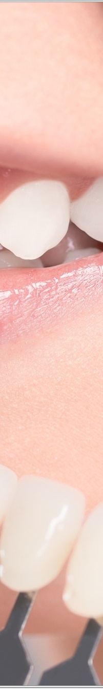 명동치과 치아 라미네이트의 모든 것: 앞니부터 어금니까지 관련 이미지 24