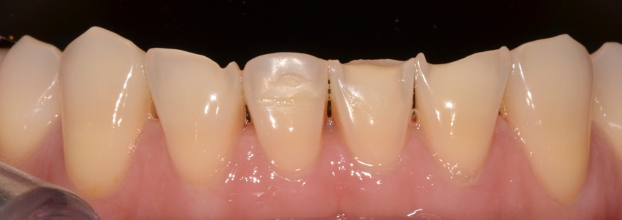 [종로치과추천] 치아가 마모되어 보기 싫어요ㅠㅠ 관련 이미지 2