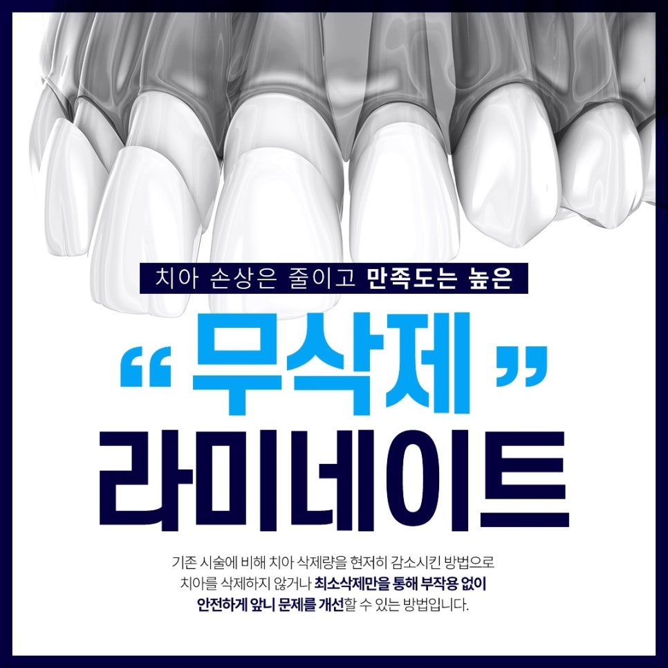 라미네이트, 어떤 경우에 필요할까? 종각역치과에서 알아보는 완벽 가이드 관련 이미지 3