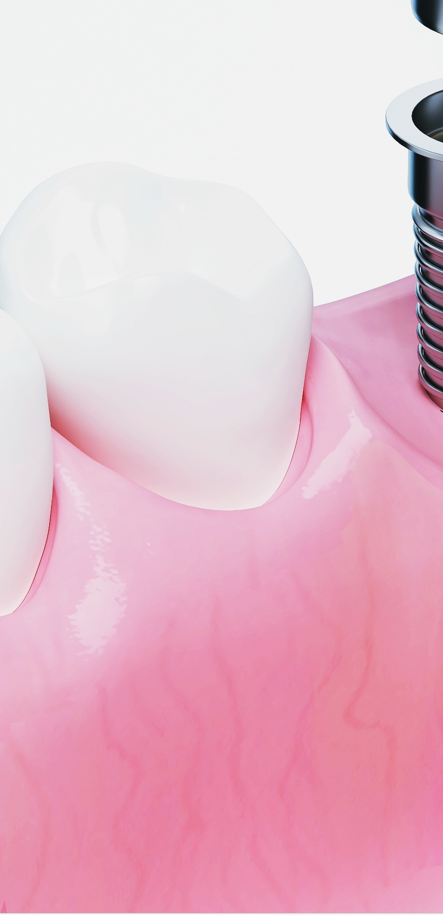 종각역치과 임플란트 치료, 이것만은 알고 계세요! 관련 이미지 43