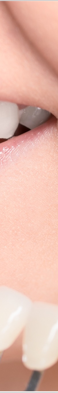 명동라미네이트, 단시간에 환한 미소를 가지고 싶다면? 관련 이미지 24