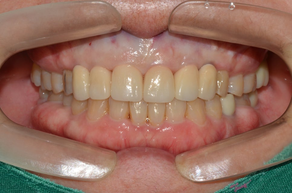 종로임플란트 아래 치아가 계속 위에 치아랑 닿는 거 같더니 위에 앞니가 깨졌어요 관련 이미지 6