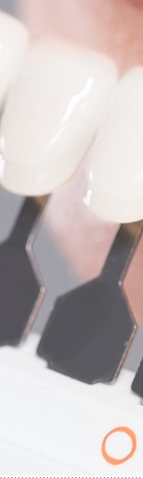 종로치과 라미네이트 주변 치아를 확인하여 자연스럽게 관련 이미지 21