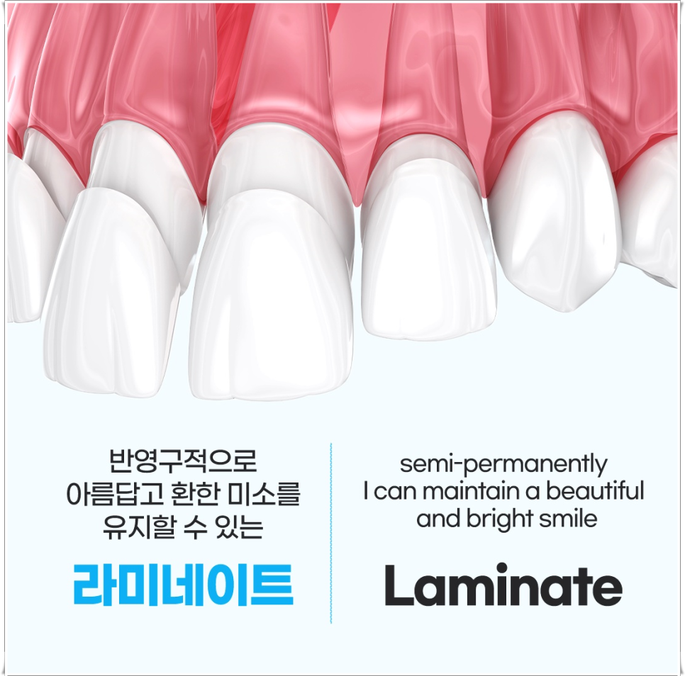 라미네이트 유지기간, 오래 사용하는 관리 방법 총정리 | 종로치과 관련 이미지 2