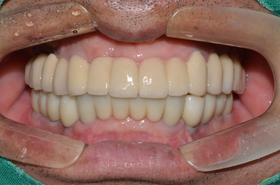 종로치과 잇몸이 붓고 전체적으로 이가 흔들려서 힘들어요 관련 이미지 3