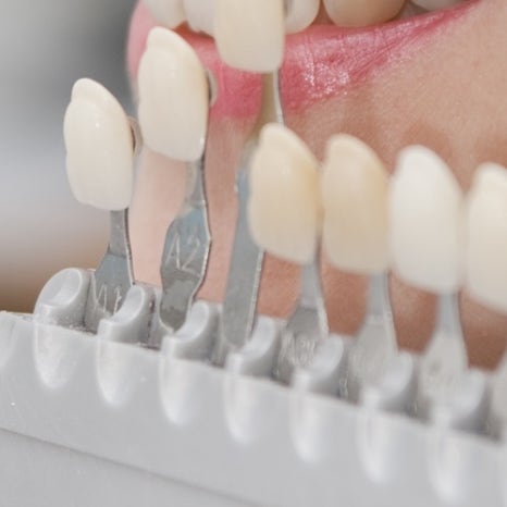 을지로입구치과 라미네이트 치료, 어디까지 알고 있나요? 관련 이미지 13