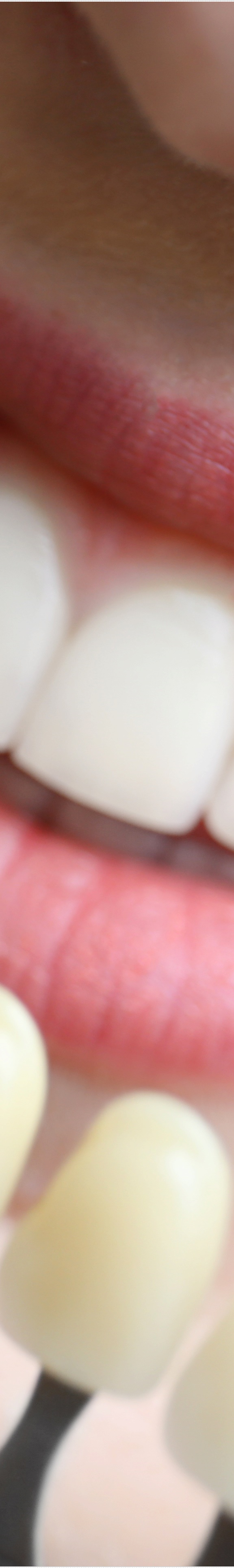 을지로입구역치과에서 알려드리는 치아미백과 라미네이트의 모든 것 관련 이미지 22