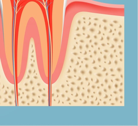 종로치과 충치가 생겼을 때 어떻게 치료 받아야 하나요? 관련 이미지 18