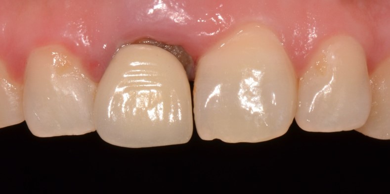 을지로치과 오래된 보철로 앞니가 보기 싫어요ㅠ 관련 이미지 2