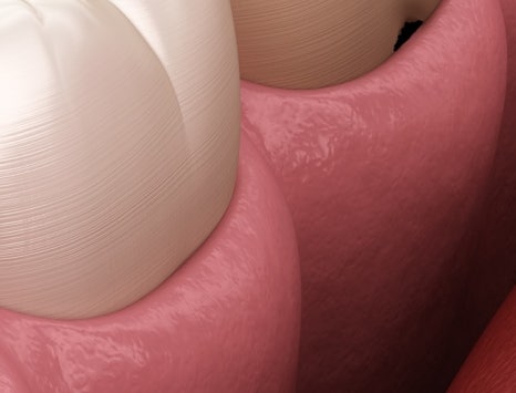 종각치과 너무 많은 치과 치료가 헷갈린다면? 관련 이미지 28