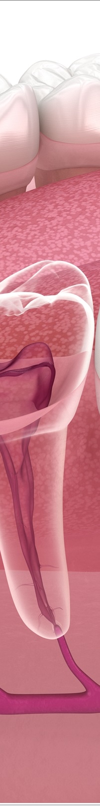 종각역치과 자연치아를 살리기 위한 대책, 신경치료 관련 이미지 15