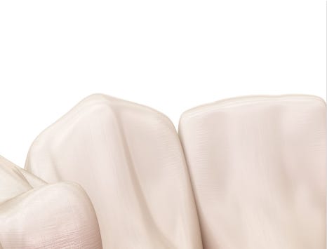 종로치과 충치가 생겼을 때 어떻게 치료 받아야 하나요? 관련 이미지 21