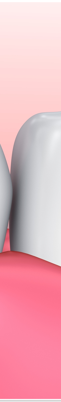 광화문역치과 치아미백과 라미네이트 나에게 필요한 건? 관련 이미지 13