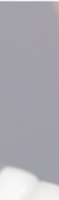 종로치과 라미네이트 주변 치아를 확인하여 자연스럽게 관련 이미지 9