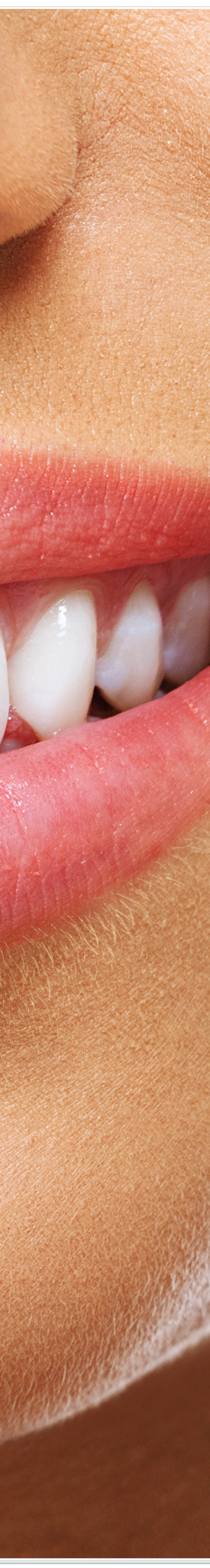 종로치과에서 알려드리는 치아미백과 라미네이트의 모든 것 관련 이미지 16