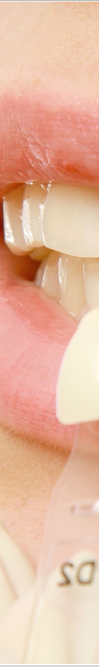 명동라미네이트, 단시간에 환한 미소를 가지고 싶다면? 관련 이미지 8