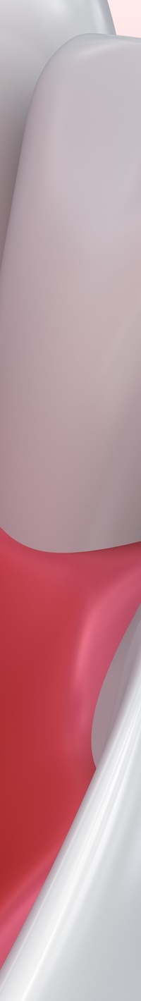 명동치과 주변 치아와 자연스러운 라미네이트 하는 방법 관련 이미지 25