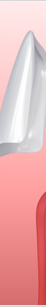 광화문치과 라미네이트 치료 전 고민해야 할 것 관련 이미지 15