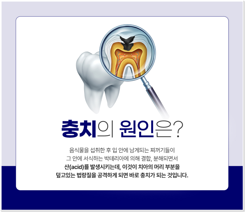 종로치과 충치치료는 조기 발견이 중요 관련 이미지 2